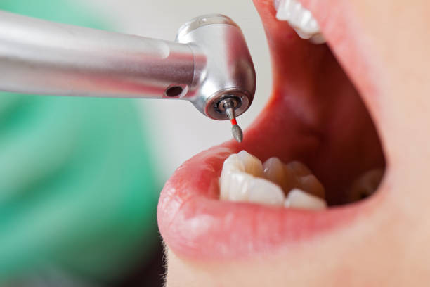 Best Emergency Dental Care for Abscessed Tooth in Ridgecrest, CA